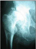 Hip Replacement Hospital India, Hip Replacement In India, Hip Resurfacing India, Hip Replacement India